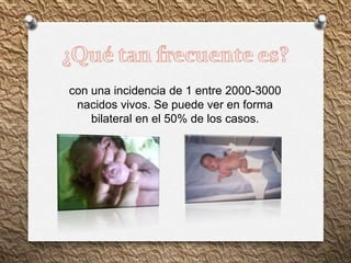 con una incidencia de 1 entre 2000-3000
nacidos vivos. Se puede ver en forma
bilateral en el 50% de los casos.
 