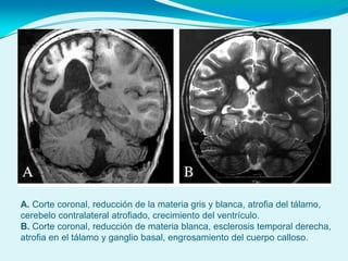 A. Corte coronal, reducción de la materia gris y blanca, atrofia del tálamo,
cerebelo contralateral atrofiado, crecimiento del ventrículo.
B. Corte coronal, reducción de materia blanca, esclerosis temporal derecha,
atrofia en el tálamo y ganglio basal, engrosamiento del cuerpo calloso.
 
