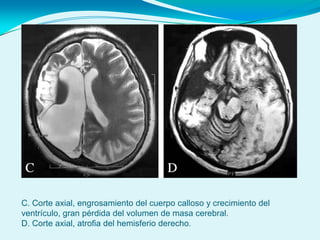 C. Corte axial, engrosamiento del cuerpo calloso y crecimiento del
ventrículo, gran pérdida del volumen de masa cerebral.
D. Corte axial, atrofia del hemisferio derecho.
 