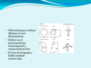  Dificultad para realizar
dibujos en tres
dimensiones.
 Déficit en el
procesamiento
visuoespacial y
visuoconstrucción.
 El área de lenguaje y
habla estaban
conservada.
 