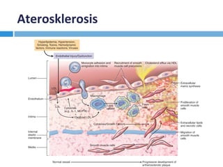 Aterosklerosis	 CHAPTER 11 Blood Vessels 501
LDL
Lumen
Endothelium
Intima
Internal
elastic
membrane
Media
LDL Cytokines
(e.g., IL-1, MCP-1)
+
Oxidized LDL
Macrophage
Lipid
uptake
Foam
cells
Cytokines/Growth Factors
Smooth muscle cells
Migration of
smooth muscle
cells
Extracellular lipids
and necrotic cells
Proliferation of
smooth muscle
cells
Extracellular
matrix synthesis
Endothelial Injury/Dysfunction
Hyperlipidemia, Hypertension,
Smoking, Toxins, Hemodynamic
factors, Immune reactions, Viruses
Normal vessel Progressive development of
artherosclerotic plaque
Monocyte adhesion and
emigration into intima
Recruitment of smooth
muscle cell precursors
Cholesterol efflux via HDL
LDL
 