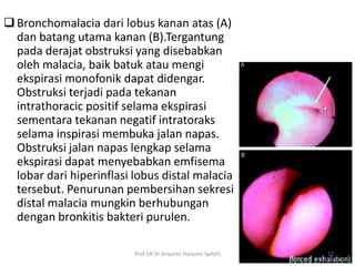  Bronchomalacia dari lobus kanan atas (A)
dan batang utama kanan (B).Tergantung
pada derajat obstruksi yang disebabkan
ol...