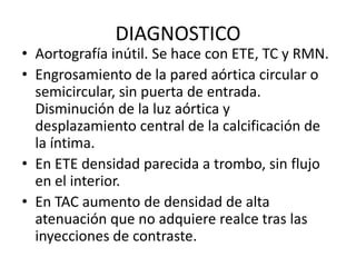Pared Inutil Sindrome aortico-agudo | PDF