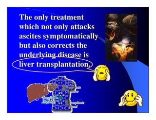 Sindrome Ascitico Edematoso