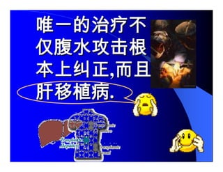 Sindrome Ascitico Edematoso