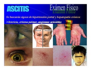 Sindrome Ascitico Edematoso