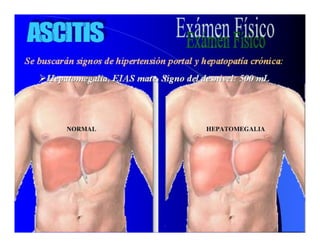 Sindrome Ascitico Edematoso