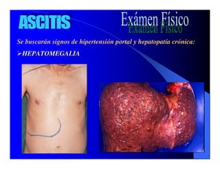 Sindrome Ascitico Edematoso