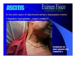 Sindrome Ascitico Edematoso