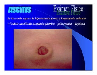 Sindrome Ascitico Edematoso