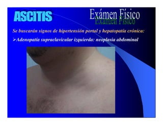 Sindrome Ascitico Edematoso