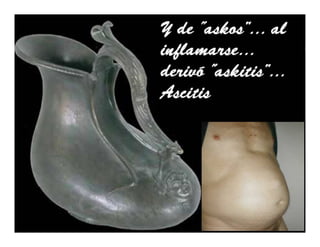 Sindrome Ascitico Edematoso