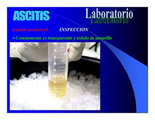 Sindrome Ascitico Edematoso