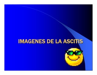 Sindrome Ascitico Edematoso