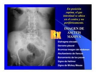 Sindrome Ascitico Edematoso