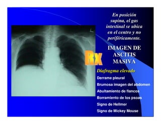 Sindrome Ascitico Edematoso