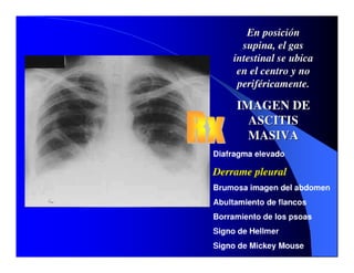 Sindrome Ascitico Edematoso