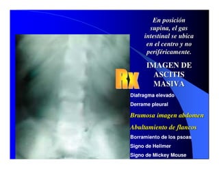 Sindrome Ascitico Edematoso