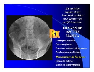Sindrome Ascitico Edematoso