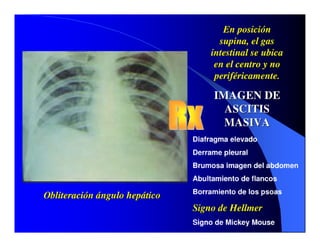 Sindrome Ascitico Edematoso