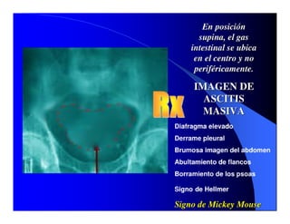 Sindrome Ascitico Edematoso