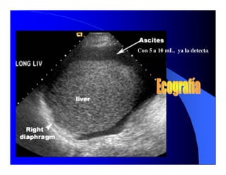 Sindrome Ascitico Edematoso