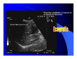 Sindrome Ascitico Edematoso