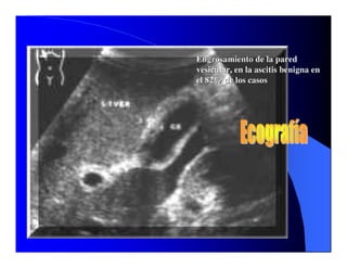 Sindrome Ascitico Edematoso