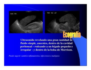 Sindrome Ascitico Edematoso