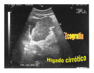 Sindrome Ascitico Edematoso