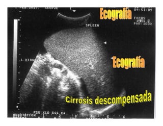 Sindrome Ascitico Edematoso