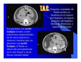 Sindrome Ascitico Edematoso