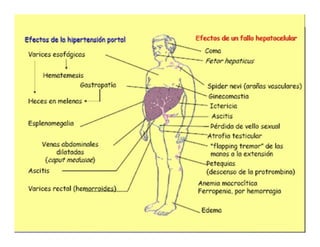 Sindrome Ascitico Edematoso