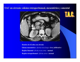 Sindrome Ascitico Edematoso
