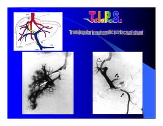 Sindrome Ascitico Edematoso