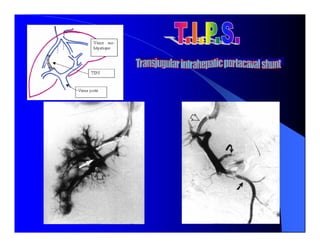 Sindrome Ascitico Edematoso
