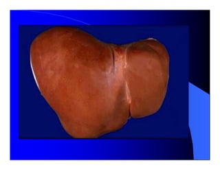 Sindrome Ascitico Edematoso