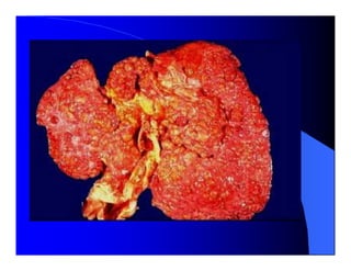 Sindrome Ascitico Edematoso