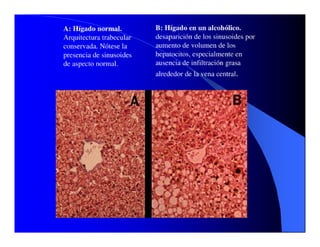 Sindrome Ascitico Edematoso