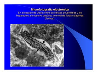 Sindrome Ascitico Edematoso