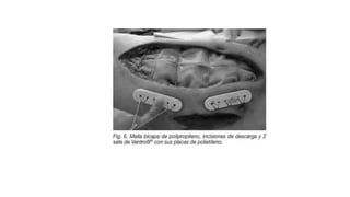 Sindrome compartimental-abdominal