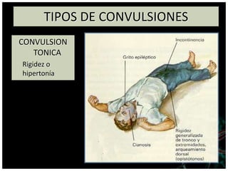 TIPOS DE CONVULSIONES
CONVULSION
TONICA
Rigidez o
hipertonía
 