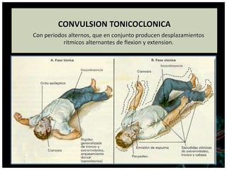 CONVULSION TONICOCLONICA
Con periodos alternos, que en conjunto producen desplazamientos
ritmicos alternantes de flexion y extension.
 