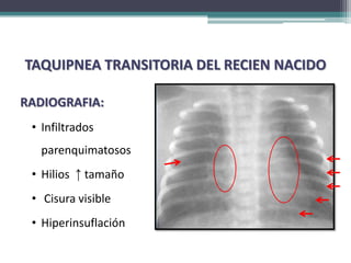 TAQUIPNEA TRANSITORIA DEL RECIEN NACIDO

RADIOGRAFIA:
 • Infiltrados
   parenquimatosos
 • Hilios ↑ tamaño
 • Cisura visible
 • Hiperinsuflación
 