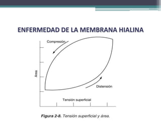 ENFERMEDAD DE LA MEMBRANA HIALINA
 