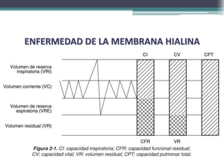 ENFERMEDAD DE LA MEMBRANA HIALINA
 