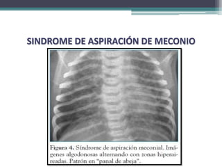 SINDROME DE ASPIRACIÓN DE MECONIO
 