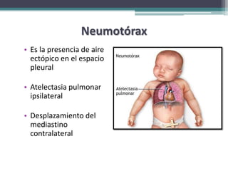 Neumotórax
• Es la presencia de aire
  ectópico en el espacio
  pleural

• Atelectasia pulmonar
  ipsilateral

• Desplazamiento del
  mediastino
  contralateral
 