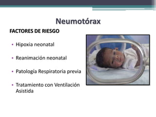 Neumotórax
FACTORES DE RIESGO

• Hipoxia neonatal

• Reanimación neonatal

• Patología Respiratoria previa

• Tratamiento con Ventilación
  Asistida
 