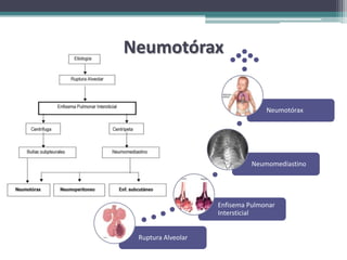 Neumotórax


                                  Neumotórax




                              Neumomediastino




                    Enfisema Pulmonar
                    Intersticial


 Ruptura Alveolar
 